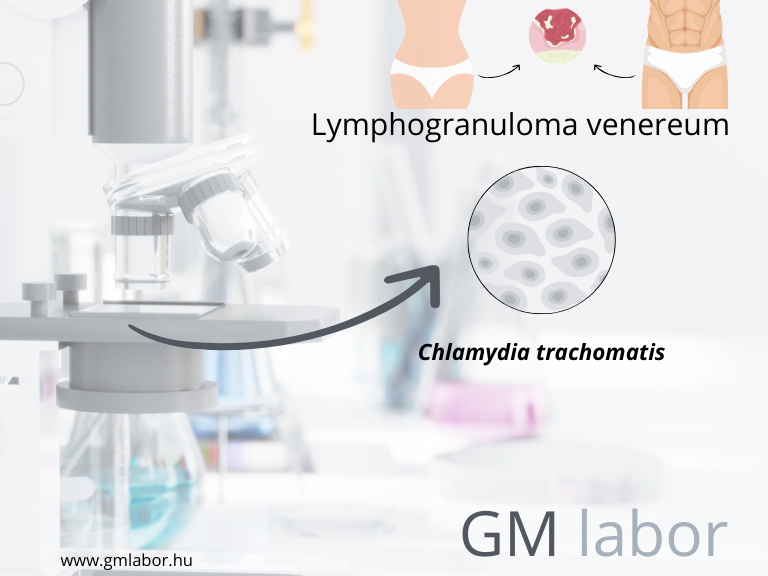 Új vizsgálat a GM laborban: Lymphogranuloma venereum (LGV) kimutatása önállóan is elérhető